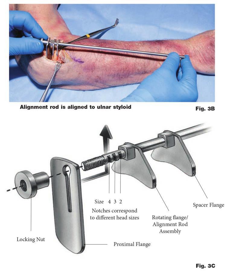 0800-2016 rhead Extended Stem Op tech (RHD-ST-2) -proof 3 rhead System Using the radial head resection guide for extended stems with 6mm collar Rotating flange The radial neck cut requires a