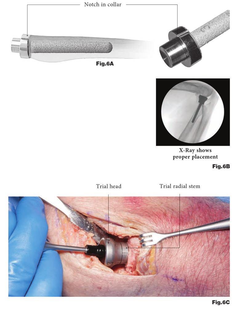 rhead System Trial stem and head insertion The appropriate sized trial stem is inserted straight into canal (Fig. 6A). The angle of the collar is directed away from the radial styloid.