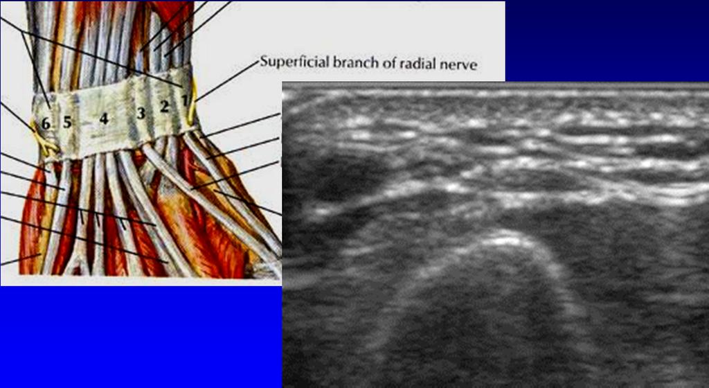 Wartenberg Syndrome: Superficial branch of radial nerve Sensory branch Crosses over distal radius and