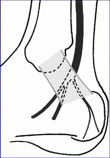 Tarsal Tunnel: Osteofibrous tunnel: medial ankle Tibial nerve Tendons: tibialis posterior, flexor digitorum longus, flexor hallucis longus Entrapment: mass, ganglion From: Martinoli, RadioGraphics