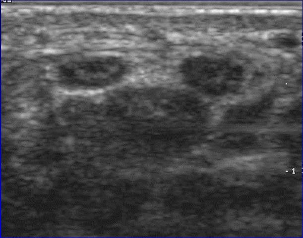 tunnel syndrome Change in crosssectional area of 4 mm 2 Proximal:
