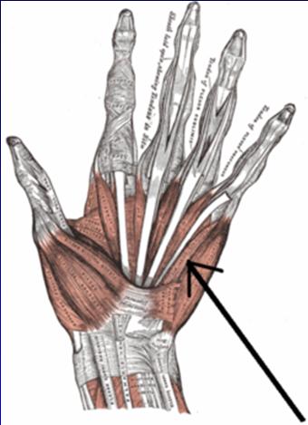 Guyon s Canal: Ulnar tunnel syndrome Ulnar nerve compression