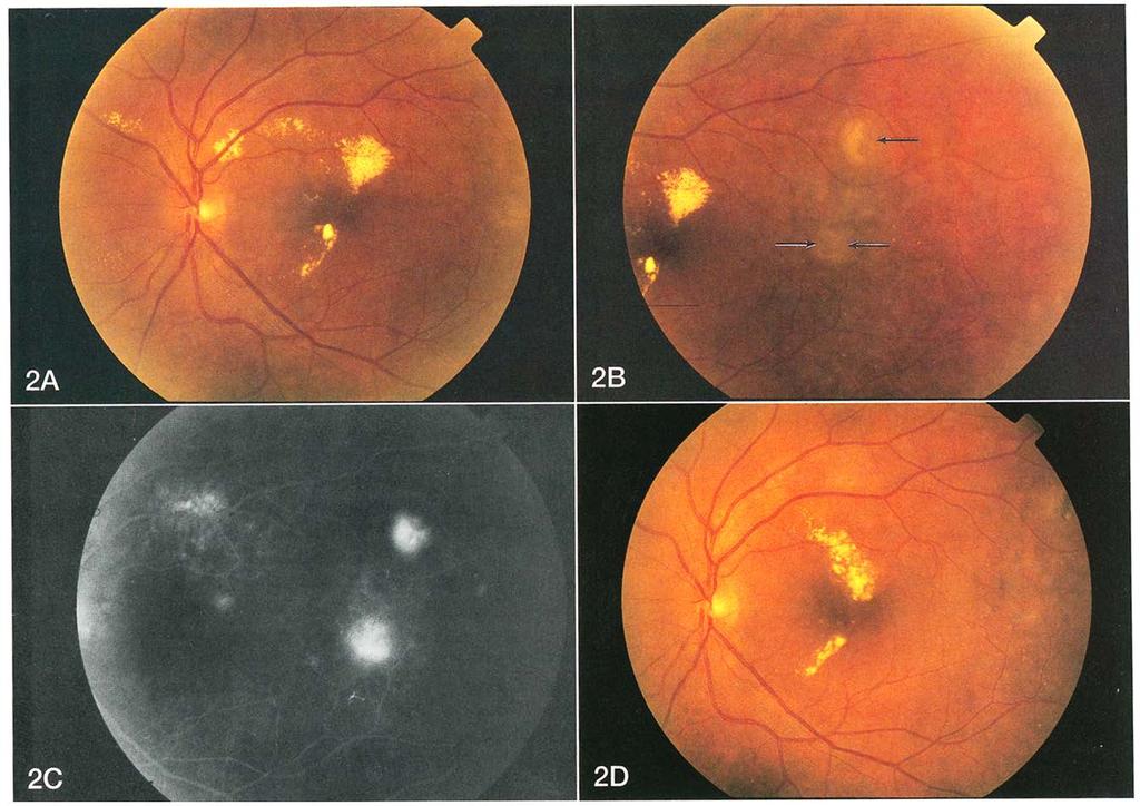 Ophthalmology Volume 103, Number 12, December 1996 Figure 2. A, left eye of a 66-year-old man with a sensory retinal detachment bounded by subretinal lipid; visual acuity was 20/40.