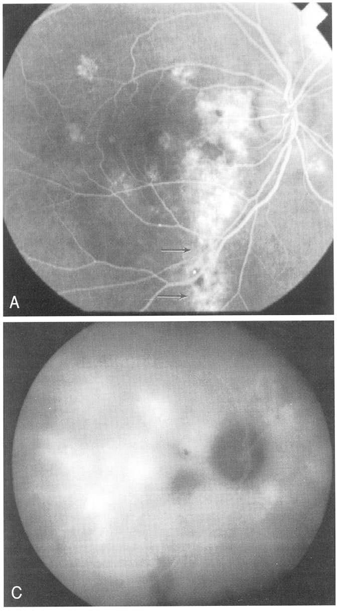 B, early phase indocyanine green angiogram showing filling of the choroidal vessels with no new vessel growth apparent.