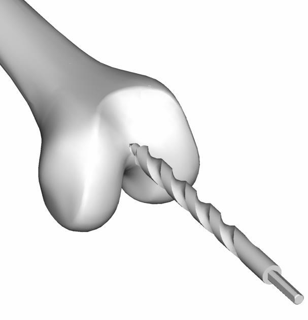 Femoral intramedullary rod - Flex the knee to 90 - Remove peripheral osteophytes - Drill the femoral medullary canal with the 8 mm drill bit - Place the entire