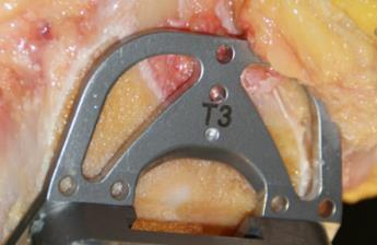 Final femoral preparation Oval clip used to attach