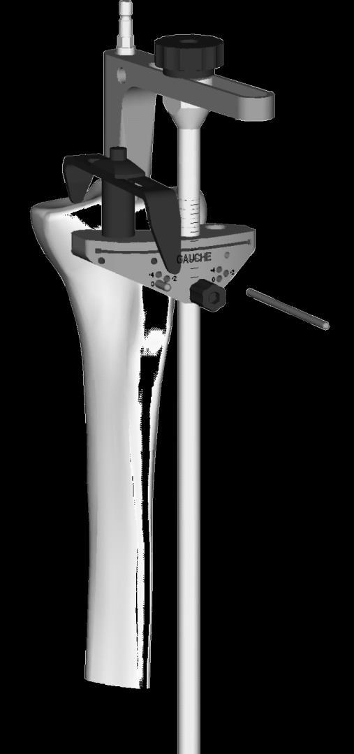 Intramedullary technique - Assemble the column on the arm with the right or left tibial cutting guide - Place the entire assembly on the