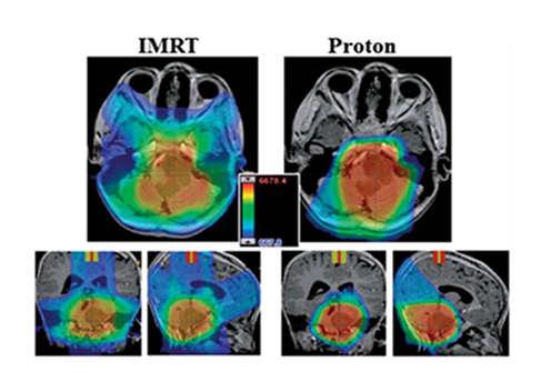 Introduction: Clinical advantage of proton therapy (PT) for childhood cancer Clinical Rationale for PT: Inverted depth dose profile Maximum dose at tumour location Sparing of surrounding normal
