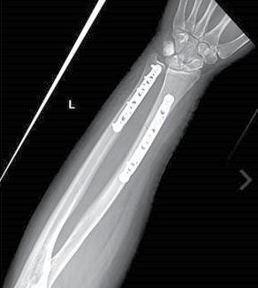 X-Rays Midshaft Volar Radius Plate 12-hole