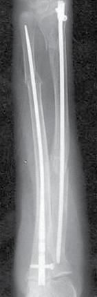 forearm fracture Ulna & Radius Rod Both-bone