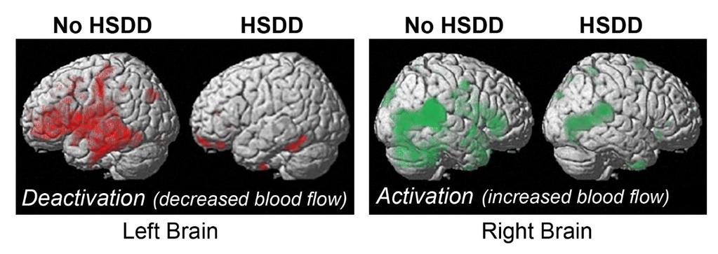 Patterns of Cortical Activation and Deactivation by Erotic Visual Cues (PET Scan) Decreased activation, observed primarily in the left hemisphere, is shown in red and increased activation, observed