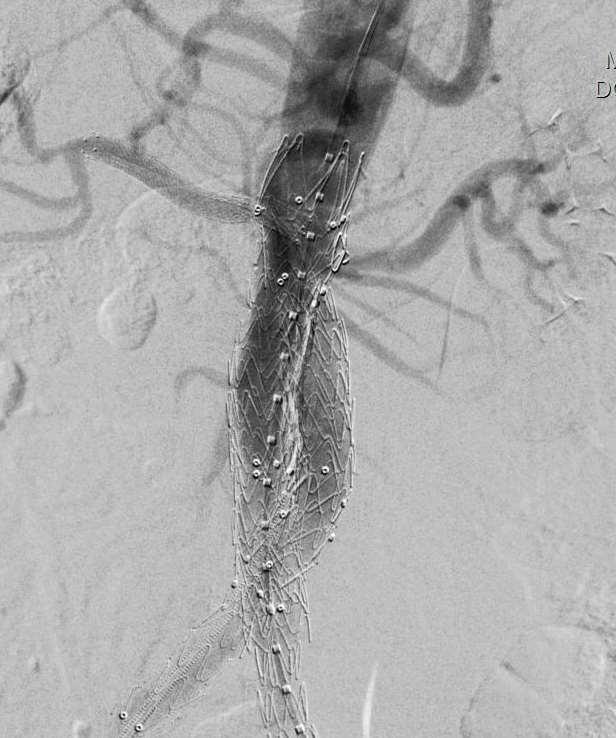Add a 6*60mm Zilver stent as R renal