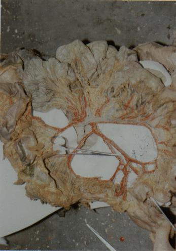 Superior Mesenteric artery: commune trunk of the Ileocolic artery with the Middle