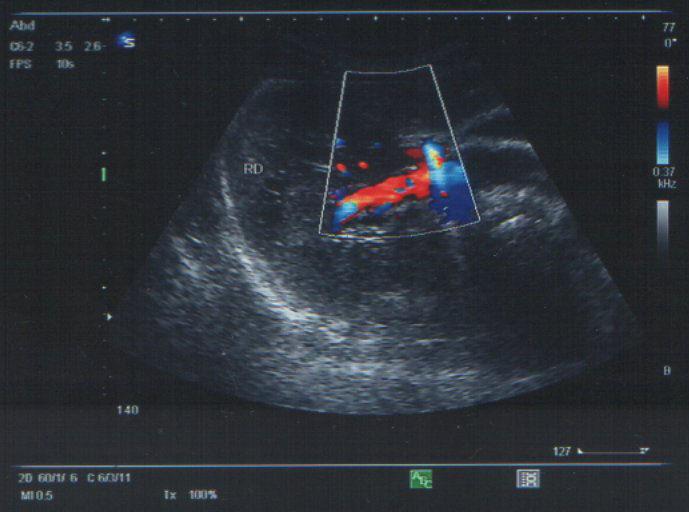 Transverse ultrasound section through the hepatic pedicle Fig. 25.