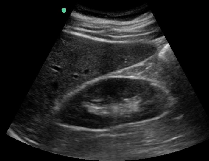 Abdominal Ultrasound : Aorta, Kidneys, Bladder Nilam J.