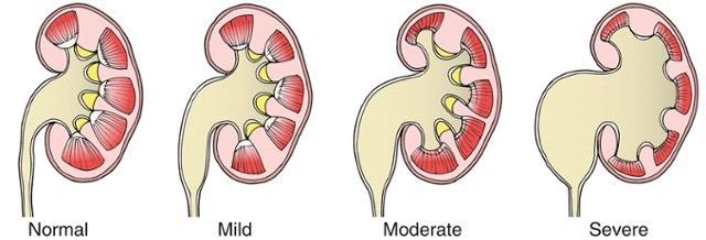 Hydronephrosis Mild = central dilation with preservation of renal pyramids Moderate = blunting of renal pyramids, rounding of calices, bear-claw