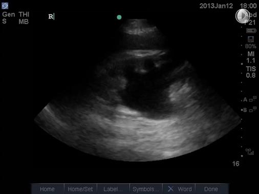 Severe Hydronephrosis From