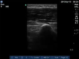Ultrasound-guided Lumbar Puncture Nilam J.