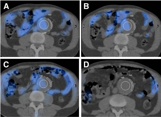 Fused axial PET/CT of ROIs applied to aortic aneurysmal wall and lumen at mid-point of