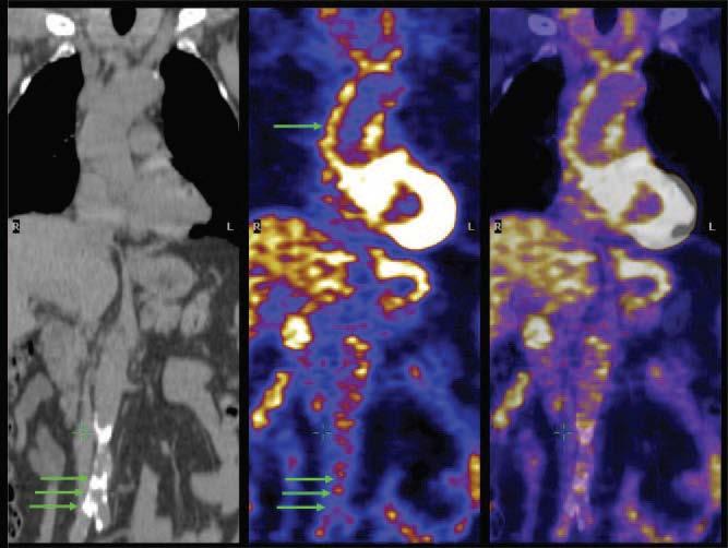 Aorta imaging with PET/CT. The left image is a noncontrast coronal CT image showing calcification of the abdominal aorta (group of 3 green arrows).