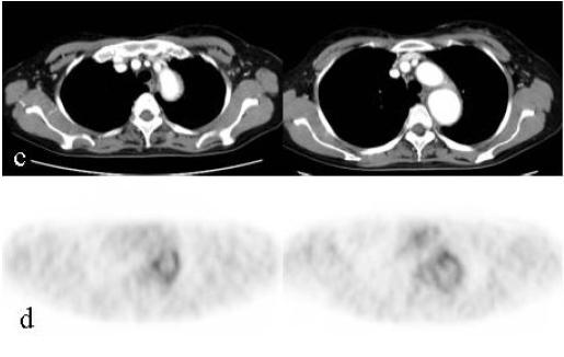 c, d: CT images show a dilated thoracic aorta with wall thickening.