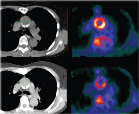 PET/CT image of aorta before (top) and during (bottom)