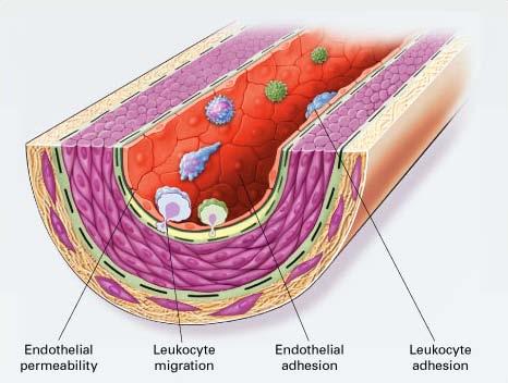 Endothelial Dysfunction in Atherosclerosis endothelial cells in early atherosclerosis begin to express molecules on their luminal surface in response