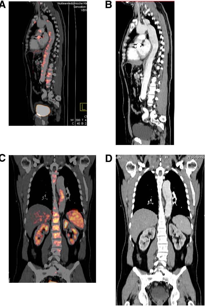 Images of 37-y-old man with acute type B dissection of aorta: sagittal (A) and coronal