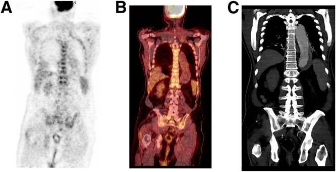 Images of 65-y-old man with chronic, stable dissection of aorta: coronal PET