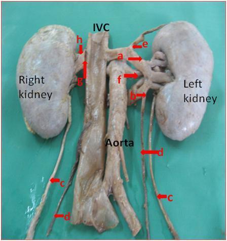 FIG 1: (Double left renal vein, Anterior view) a=left pre aortic renal vein; b= Left post aortic renal vein; c= ureter; d= gonadal vein; e=left