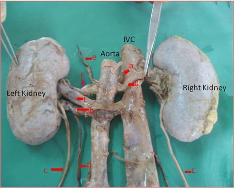 FIG 2: (Posterior view) a pre aortic left renal vein (partially hidden) b- post aortic left renal vein c- ureter d- left gonadal vein e- left
