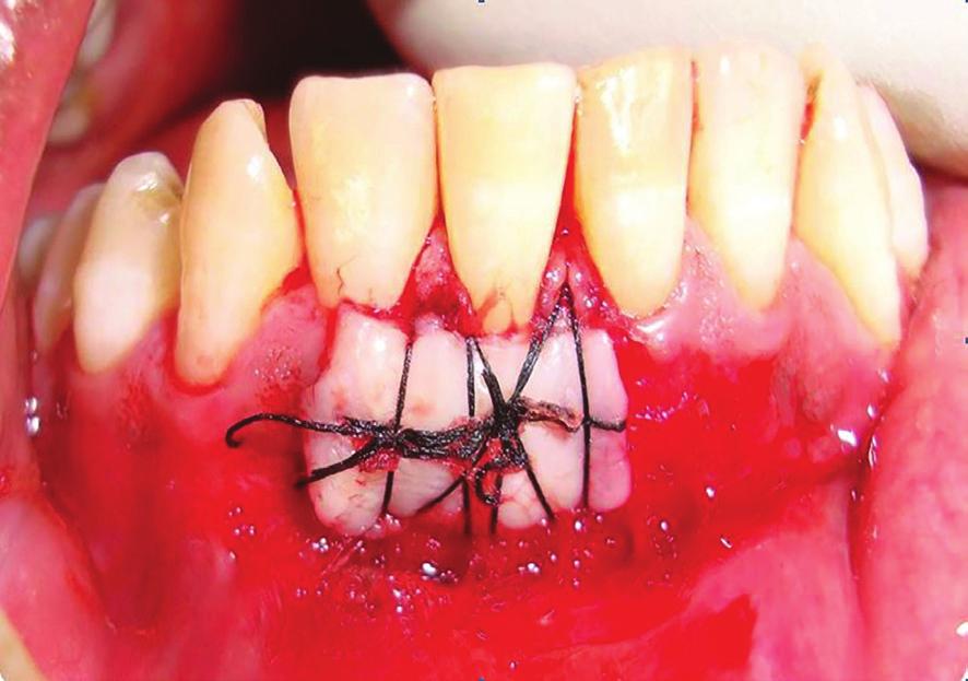 14 Gingival graft in mandibular defect attachment level (CAL) was measured as the distance in millimeters from the cementoenamel junction to the base of the sulcus and assessed from recession depth