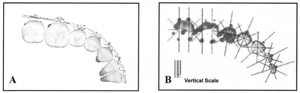 442 Sung et al April 2003 Fig 1. A, Alignment of teeth with straight-wire appliance; B, cross-sectional tooth image on CT image.