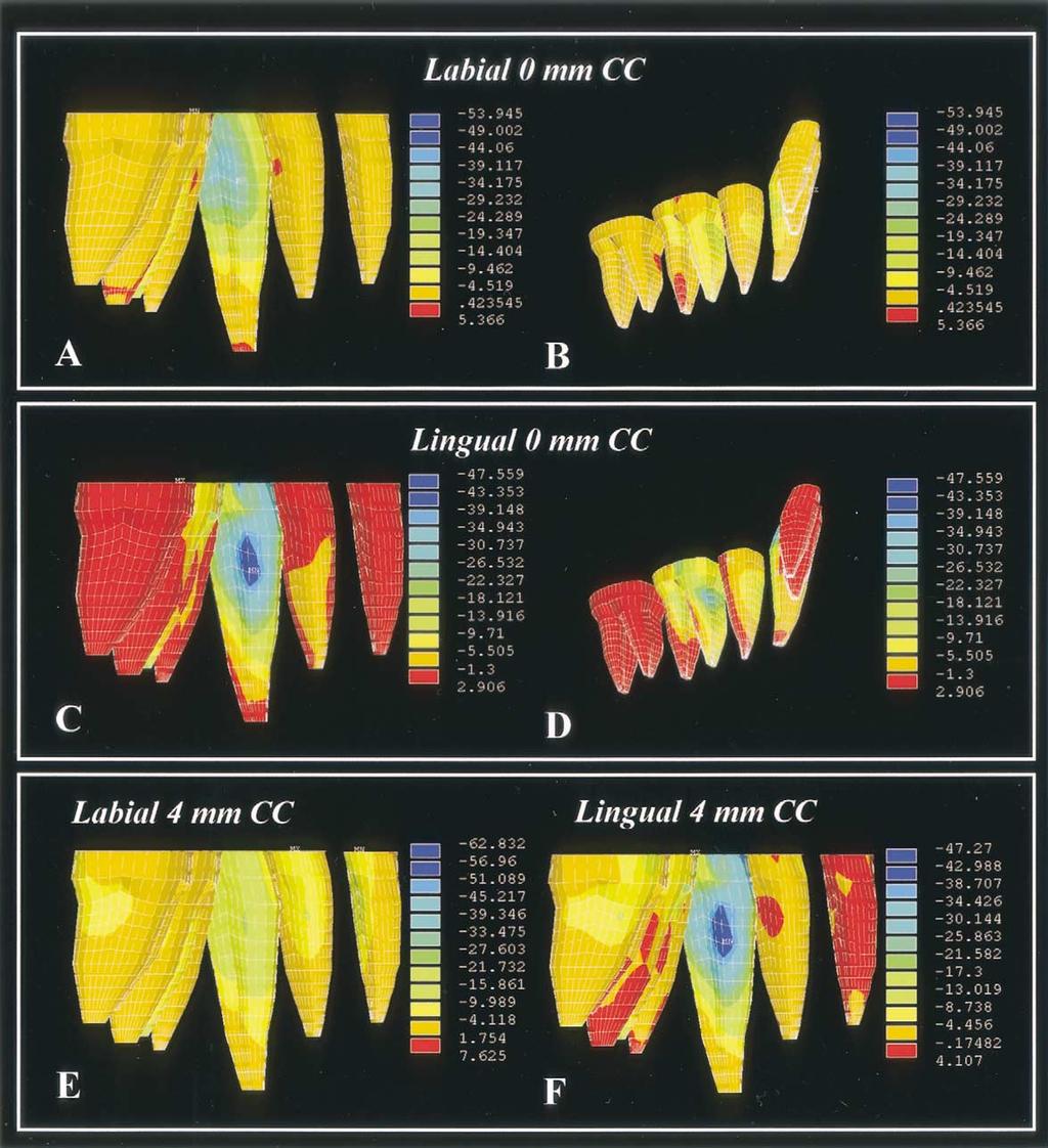 Volume 123, Number 4 Sung et al 447 Fig 7. Distribution of minimum principal stress on root during canine retraction with.016-in SS archwire. A, Compressive stress of 34.