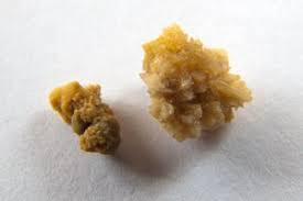 Kidney stones A kidney stone is chemicals from your urine that stick together in kind of a rock/stone formation.