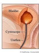 Cystoscopy Cystoscopy = visual examination of the urinary bladder using a cystoscope.
