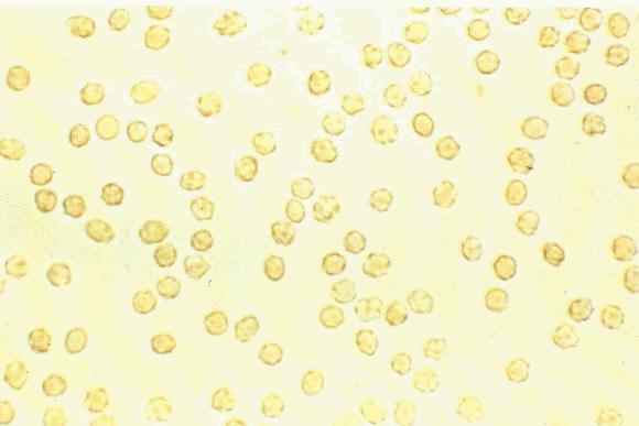 Cells found in Urine Blood cells