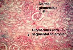 Nephrotic Syndrome: Etiologies: idiopathic, immune complex deposition or secondary disease processes (diabetes,