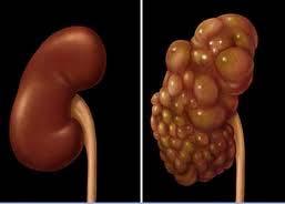 Polycystic Kidney Disease: Treatment: There is no cure, so treatment aims at slowing the progress of the disease and reducing symptoms such as controlling hypertension, pain