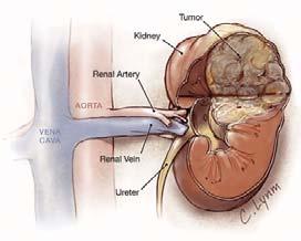 Kidney Cancer: Renal Cell Carcinoma: Primarily arises from proximal convoluted tubular cells Risk factors: smoking, obesity, heavy metal and asbestos exposure, cystic kidney disease Manifestations: