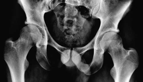 172 K. ITO, M.-A. MINKA-II, M. LEUNIG, S. WERLEN, R.GANZ Fig. 1a Fig. 1b Radiographs from a 24-year-old man with bilateral groin pain limiting flexion in internal rotation by 10.