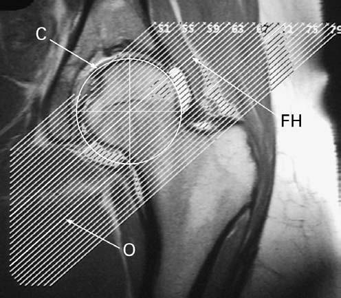 FEMOROACETABULAR IMPINGEMENT AND THE CAM-EFFECT 173 criterion for sphericity. If necessary, the Huynh-Feldt adjusted F values were used to determine significant effects.
