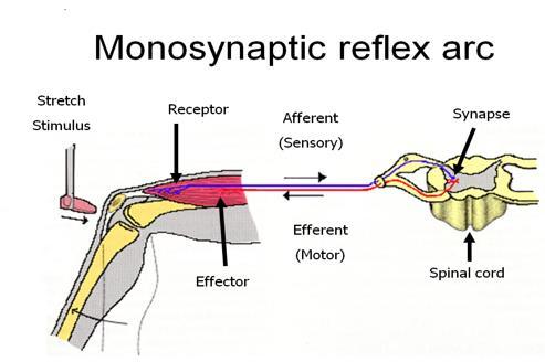 Patterns of weakness In an Upper Motor Neurone lesion, there is weakness of the; o extensors in the arms o flexors in the legs o The unopposed action of unaffected muscles produces the characteristic