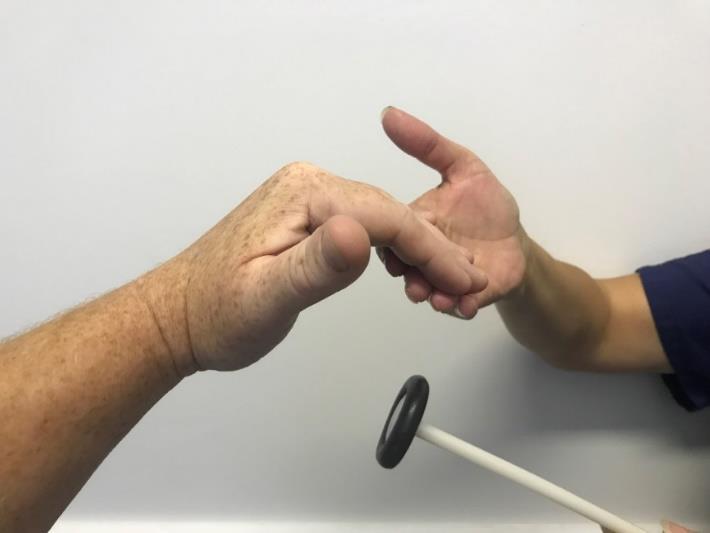The upper limb reflex testing index/middle finger(s) over supinator tendon Strike finger(s) with falling head of hammer Observe slight