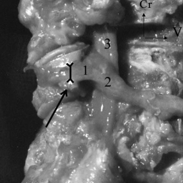 Evaluation of Cervical Lateral Mass Fixation Barrey et al E141 Materials and Methods Twenty-four adult cervical spines were harvested from fresh human cadavers coming from the department of anatomy