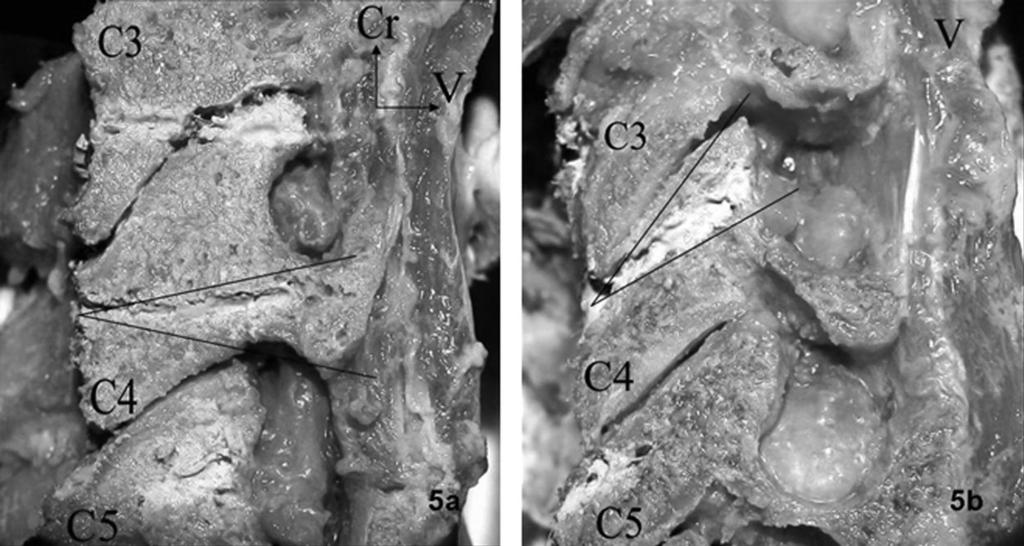 Evaluation of Cervical Lateral Mass Fixation Barrey et al E143 Figure 5. Photographs showing sagittal sections of cervical spines.