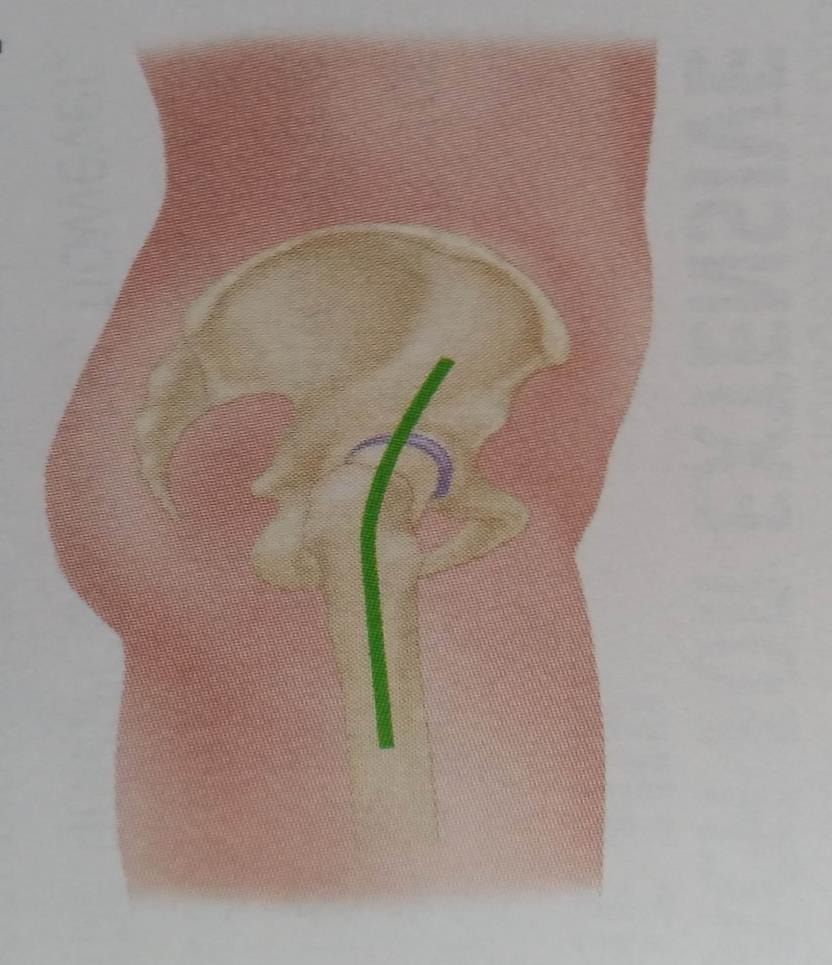 LATERAL APPROACH TO THE HIP (WATSON-JONES) Begin an incision 2.