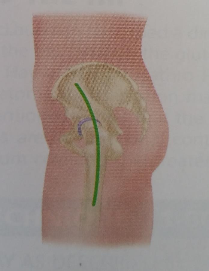 LATERAL APPROACH TO THE HIP PRESERVING THE GLUTEUS MEDIUS (MCFARLAND AND OSBORNE) Make a midlateral skin incision centered over the