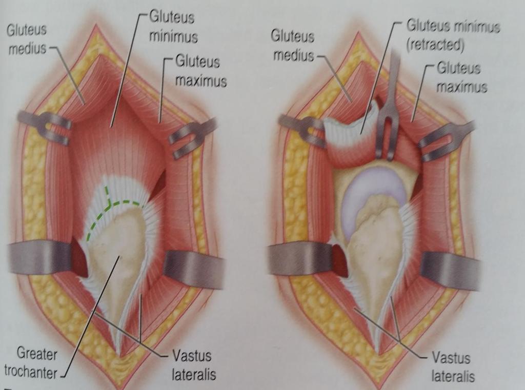 LATERAL APPROACH TO THE HIP PRESERVING THE GLUTEUS MEDIUS (MCFARLAND AND OSBORNE) Split, divide, and proximally retract the tendon of the gluteus minimus to expose the capsule of the hip joint.