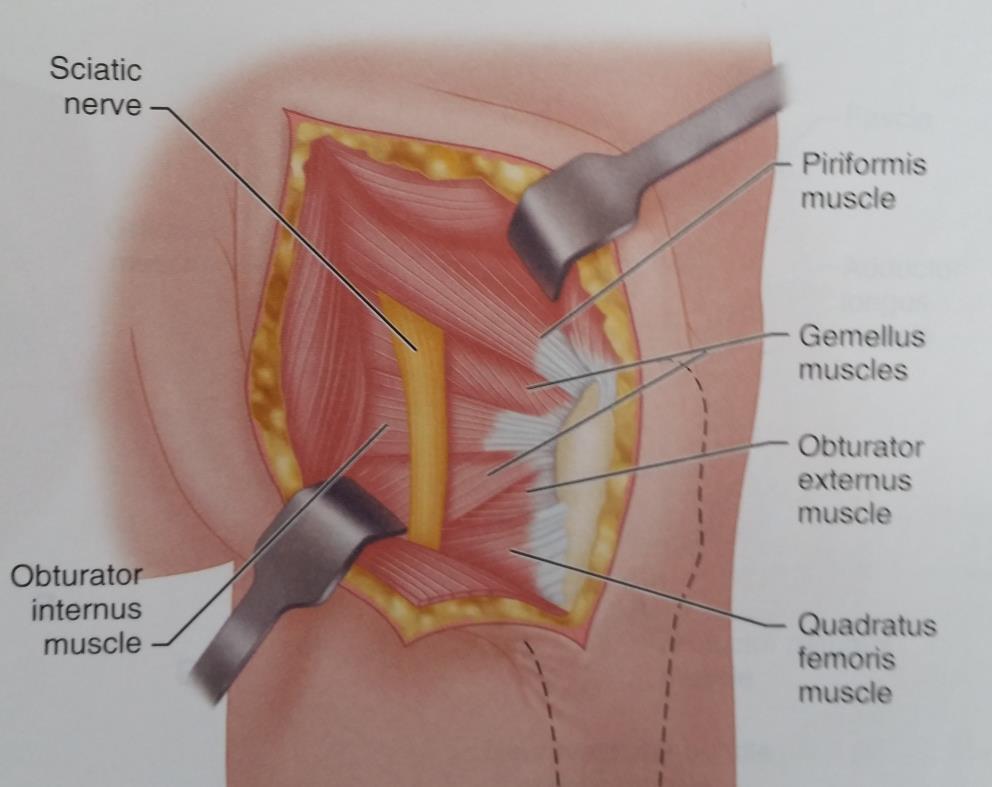 POSTERIOR APPROACH TO THE HIP (OSBORNE) Separate the fibers of the gluteus maximus parallel with the line of incision, no more than 7 cm to protect the branches of